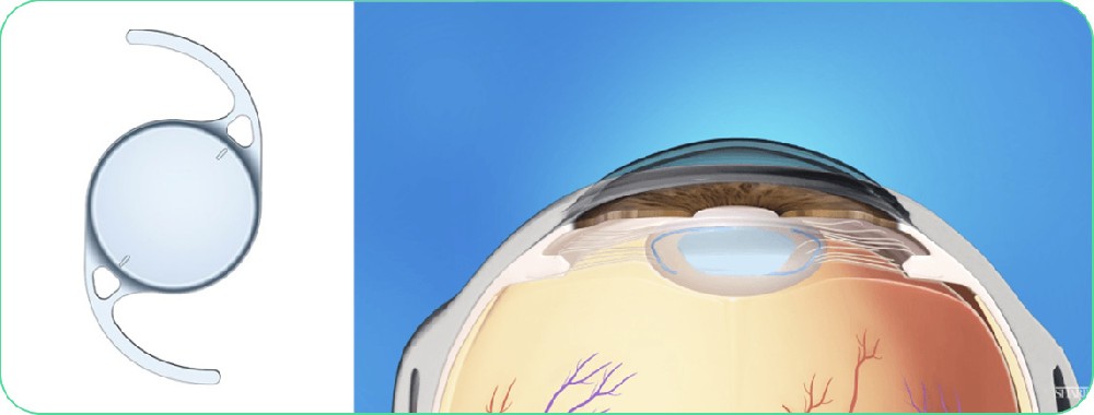 希瑪眼科中心_白內障手術_微創超聲乳化白內障切除術