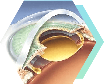 希瑪眼科中心_白內障手術_人工晶體