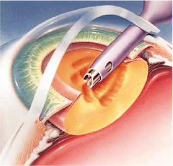  CMER Eye Center_ treatment of cataract_ phacoemulsification