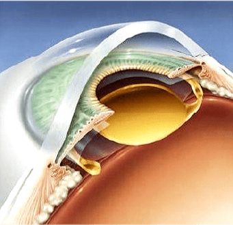 CMER Eye Center_ treatment of cataract_ cataract surgery recovery