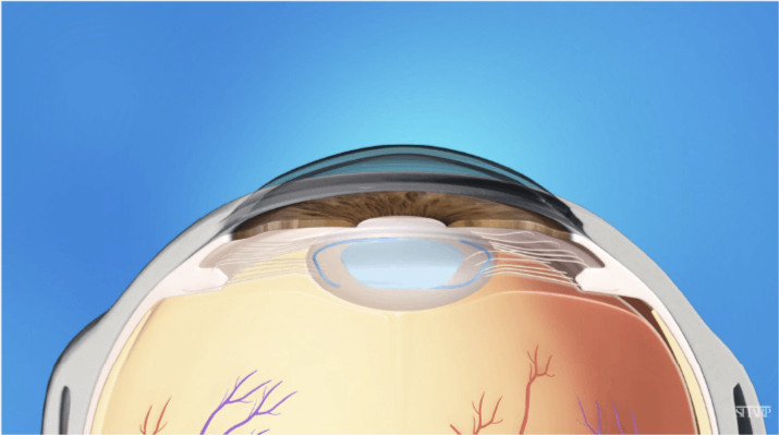 CMER Eye Center_ treatment of cataract_ cataract surgery
