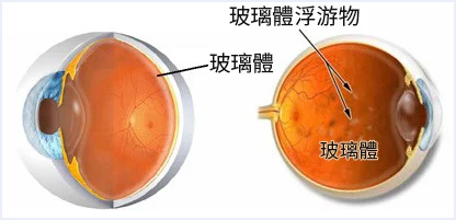 希瑪眼科中心_飛蚊症種類_惡性飛蚊
