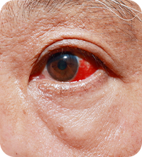 希瑪眼科中心_飛蚊症成因_眼睛退化