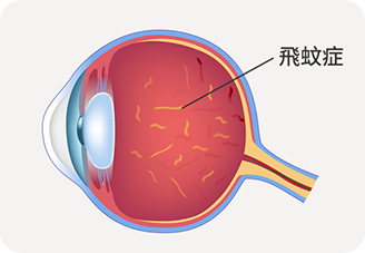 希瑪眼科中心_飛蚊症治療