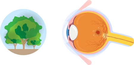 希瑪眼科中心_濕性黃班病變