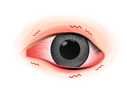 希瑪眼科中心_結膜炎症狀_眼睛痕癢疼痛