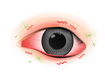 希瑪眼科中心_過敏性結膜炎