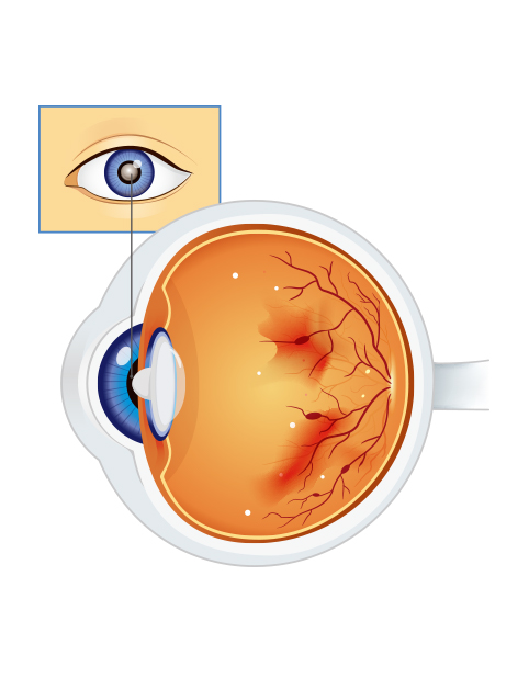 希瑪眼科中心_糖尿性視網膜病變